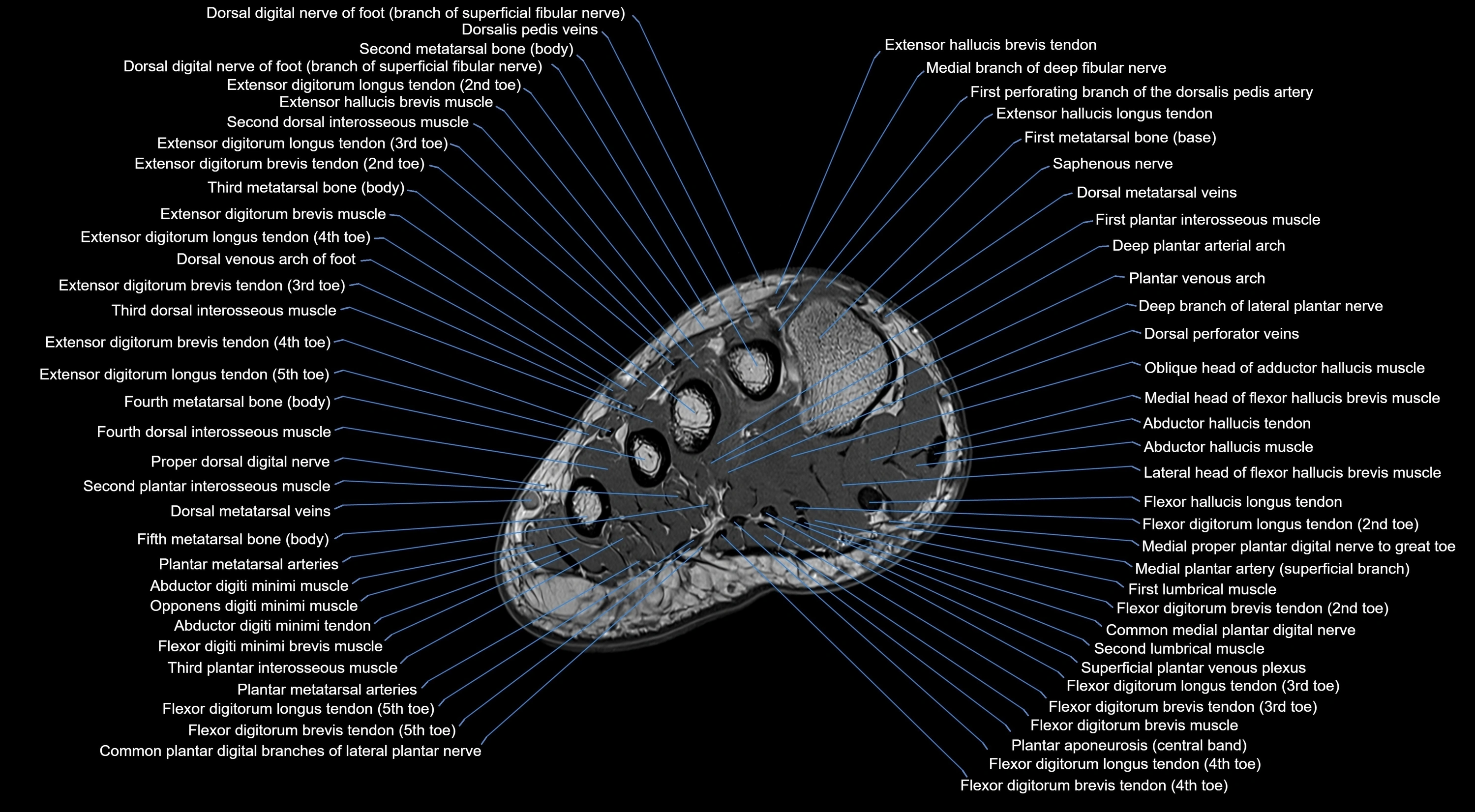 MRI mid foot coronal ligaments cross sectional anatomy 3T  radiology  image-img-00001-00008.webp